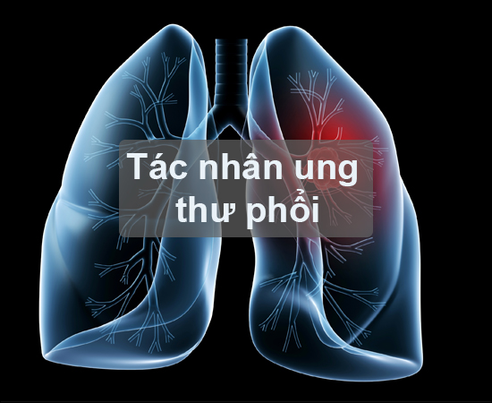 Hình ảnh ung thư phổi